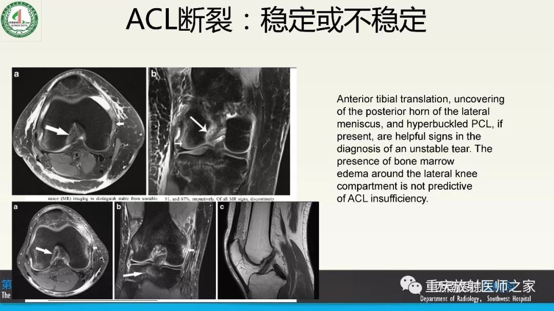 【PPT】膝关节韧带MRI诊断要点-58