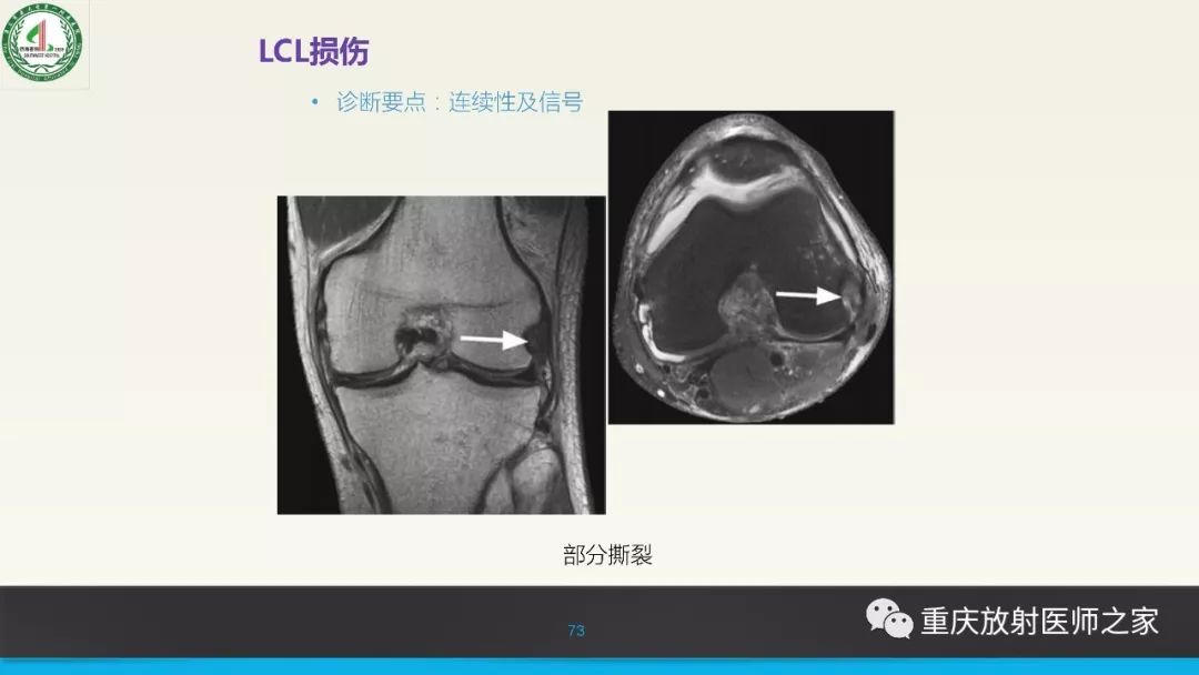【PPT】膝关节韧带MRI诊断要点-73