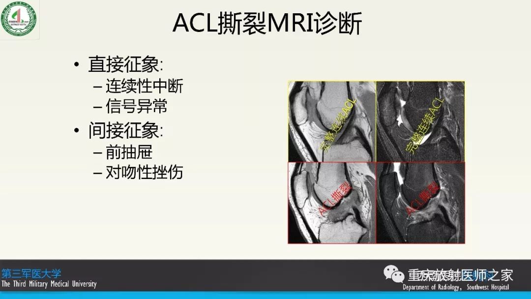 【PPT】膝关节韧带MRI诊断要点-59
