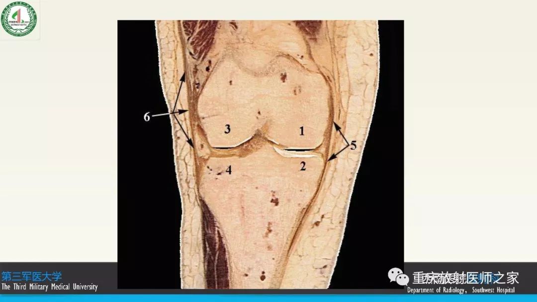 【PPT】膝关节韧带MRI诊断要点-14