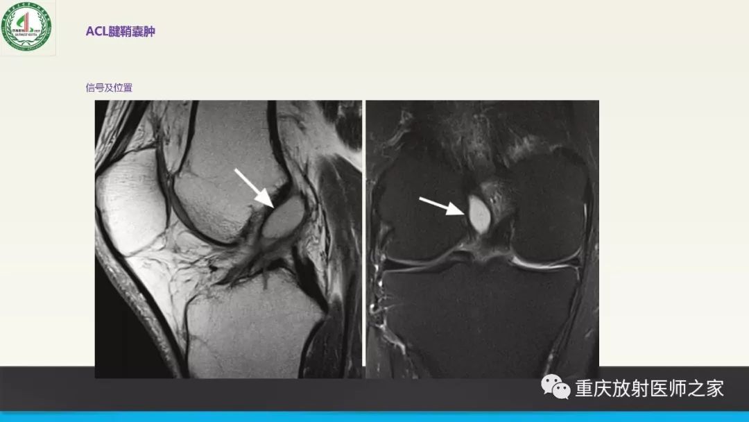【PPT】膝关节韧带MRI诊断要点-57