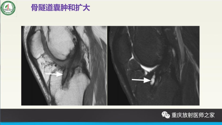 【PPT】膝关节韧带MRI诊断要点-82