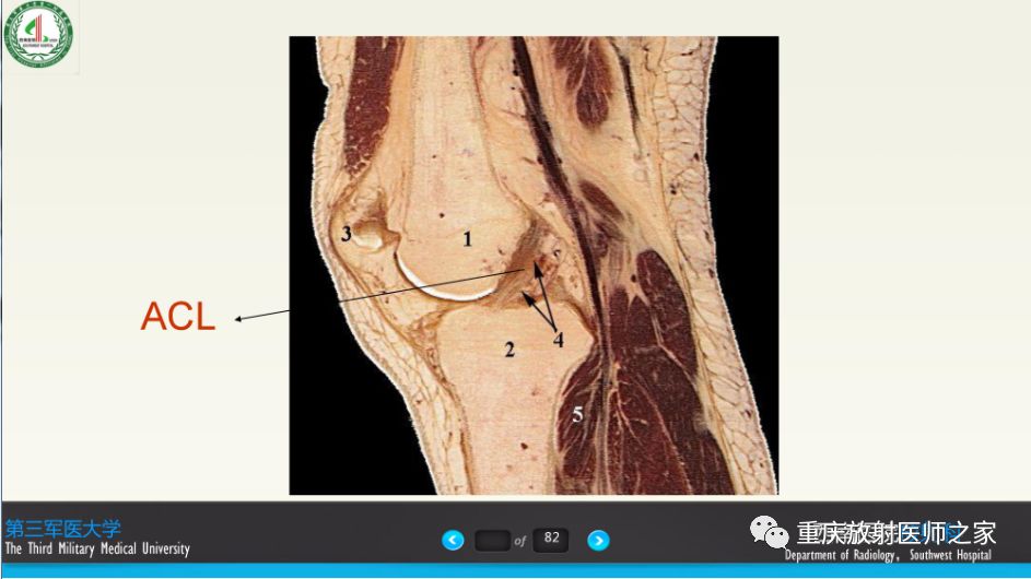 【PPT】膝关节韧带MRI诊断要点-6
