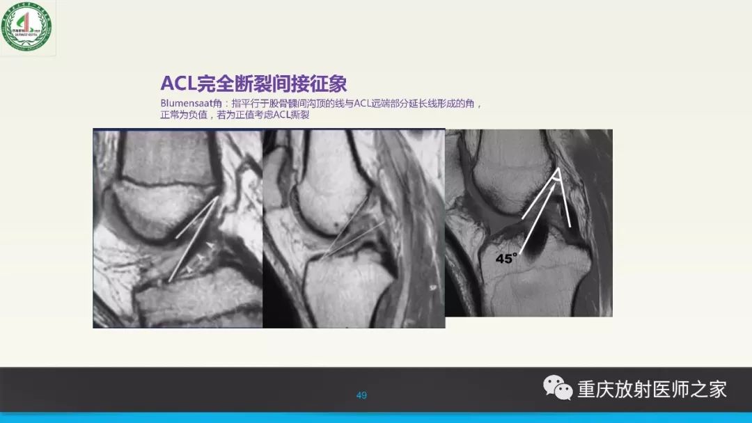 【PPT】膝关节韧带MRI诊断要点-49