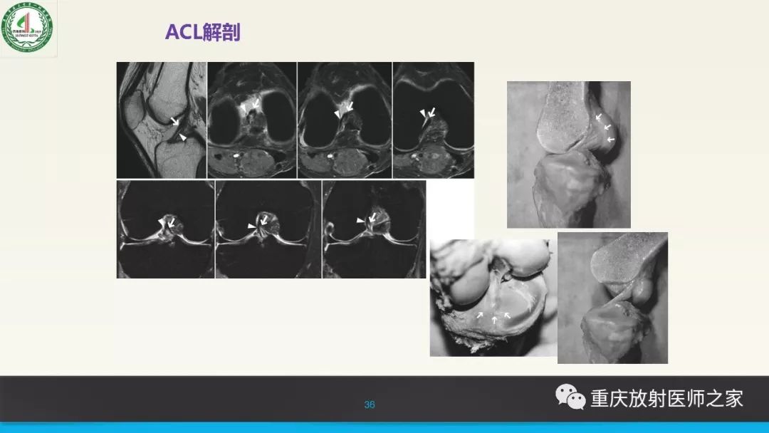 【PPT】膝关节韧带MRI诊断要点-36