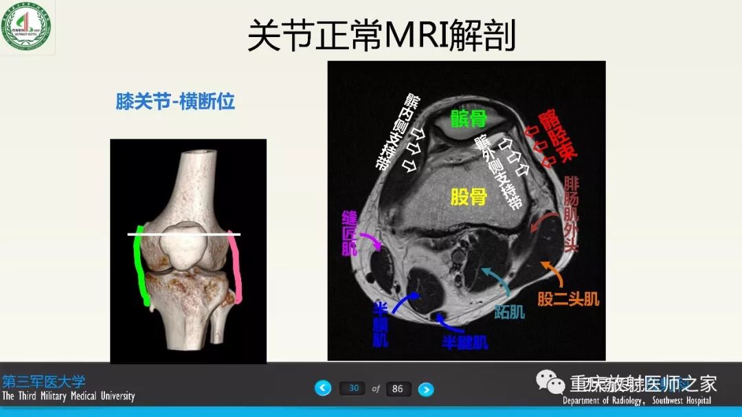 【PPT】膝关节韧带MRI诊断要点-30