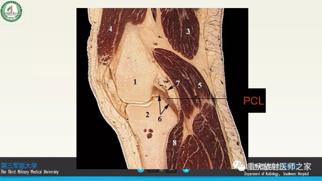【PPT】膝关节韧带MRI诊断要点-7