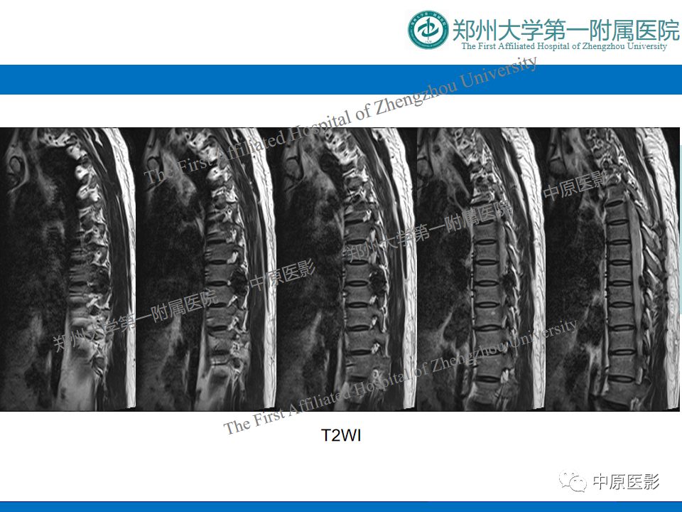 【病例】脊柱胸椎腱鞘巨细胞瘤1例CT及MR-4