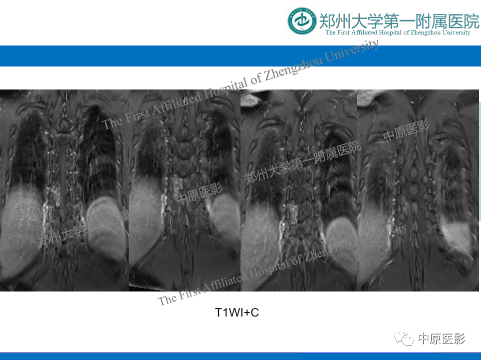 【病例】脊柱胸椎腱鞘巨细胞瘤1例CT及MR-7
