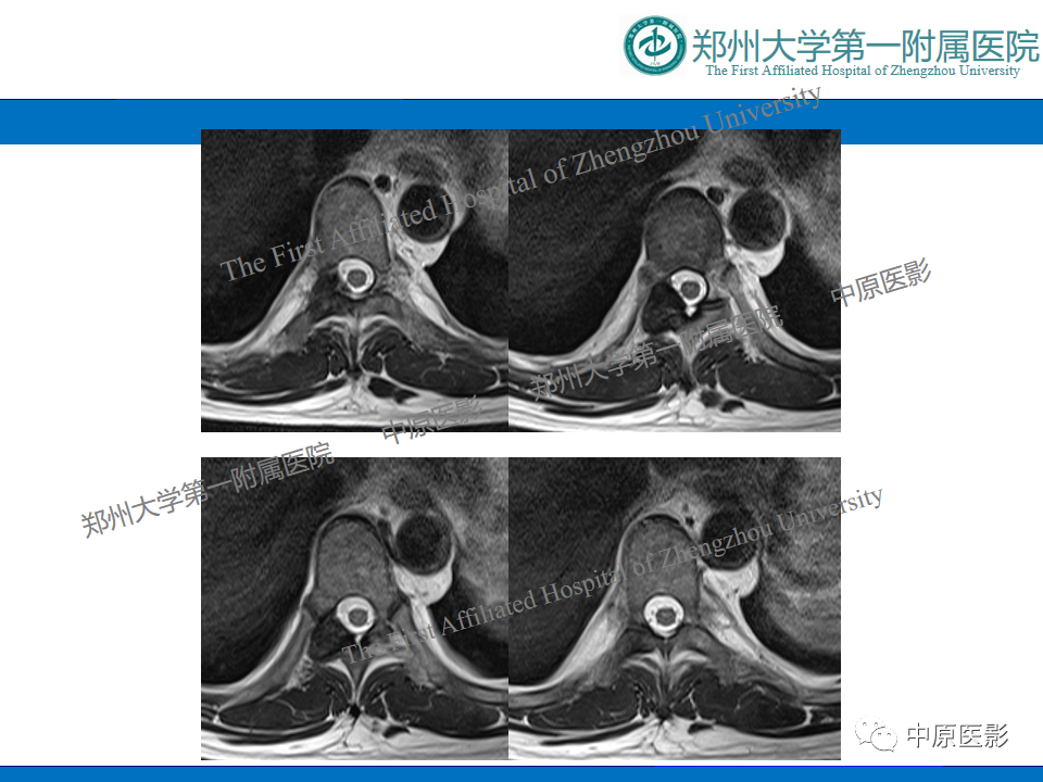 【病例】脊柱胸椎腱鞘巨细胞瘤1例CT及MR-6