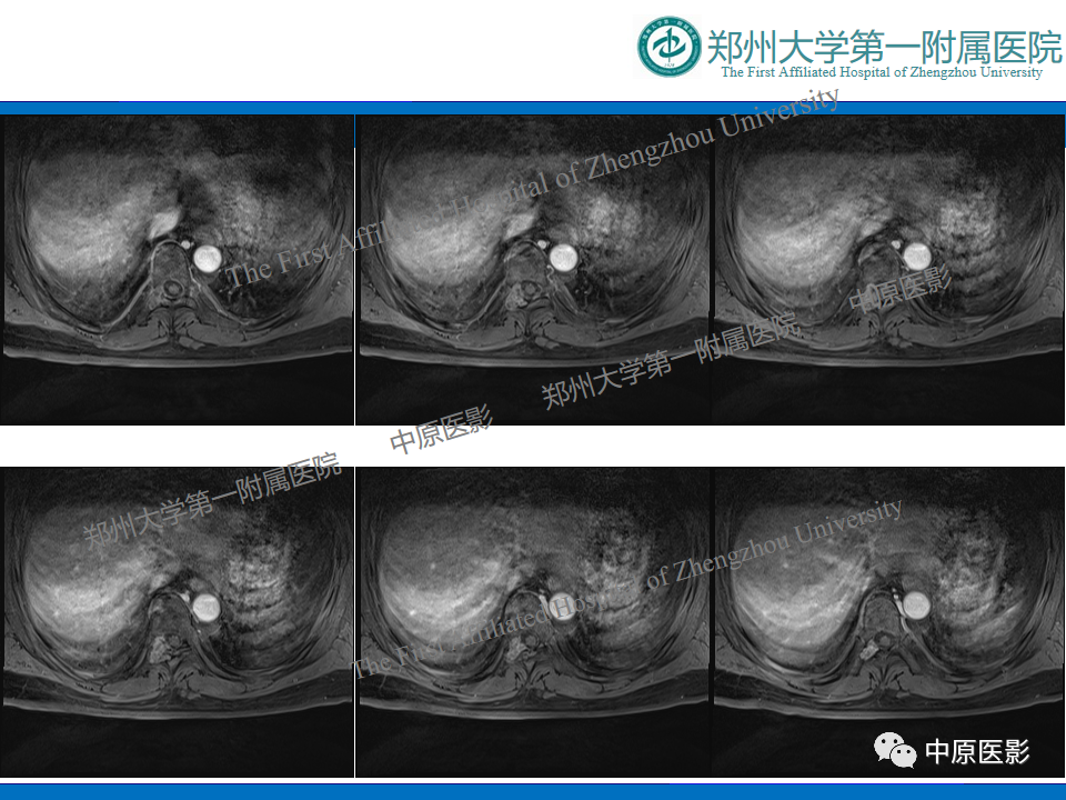 【病例】脊柱胸椎腱鞘巨细胞瘤1例CT及MR-9