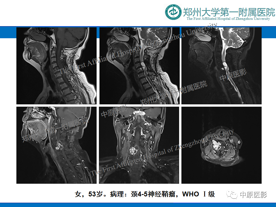 【病例】脊柱胸椎腱鞘巨细胞瘤1例CT及MR-15
