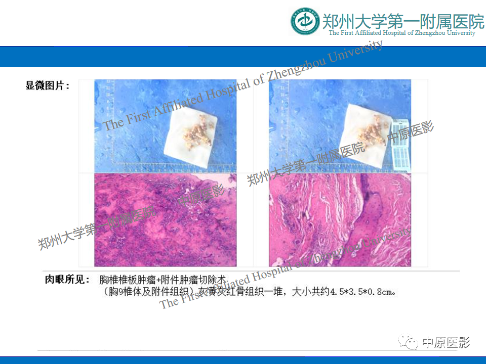 【病例】脊柱胸椎腱鞘巨细胞瘤1例CT及MR-2
