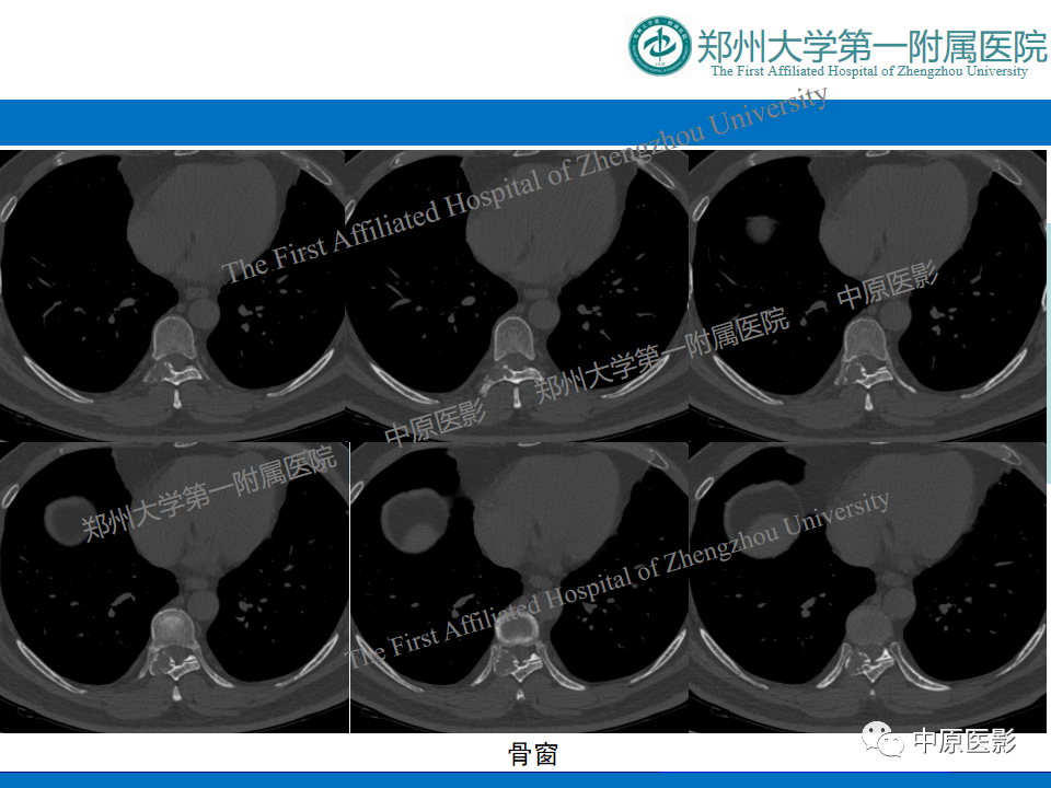 【病例】脊柱胸椎腱鞘巨细胞瘤1例CT及MR-11