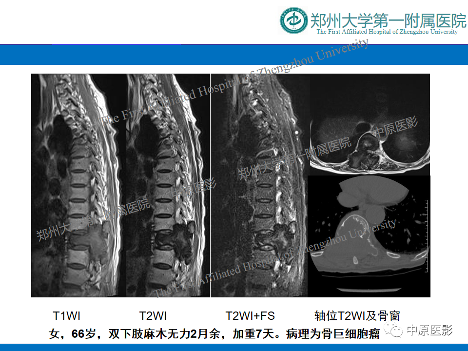 【病例】脊柱胸椎腱鞘巨细胞瘤1例CT及MR-12