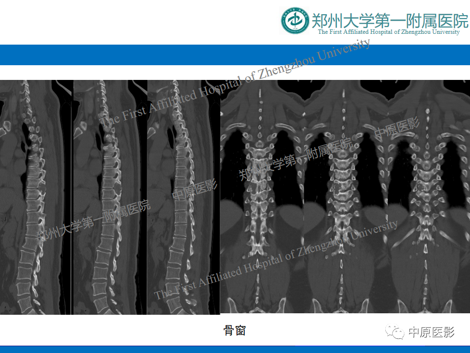 【病例】脊柱胸椎腱鞘巨细胞瘤1例CT及MR-10
