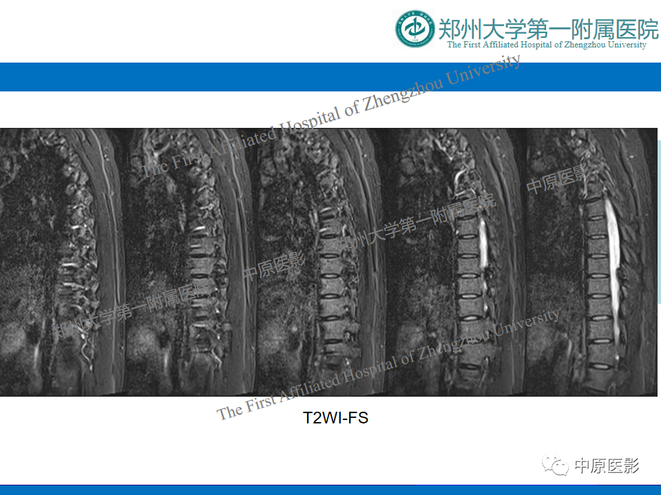 【病例】脊柱胸椎腱鞘巨细胞瘤1例CT及MR-5