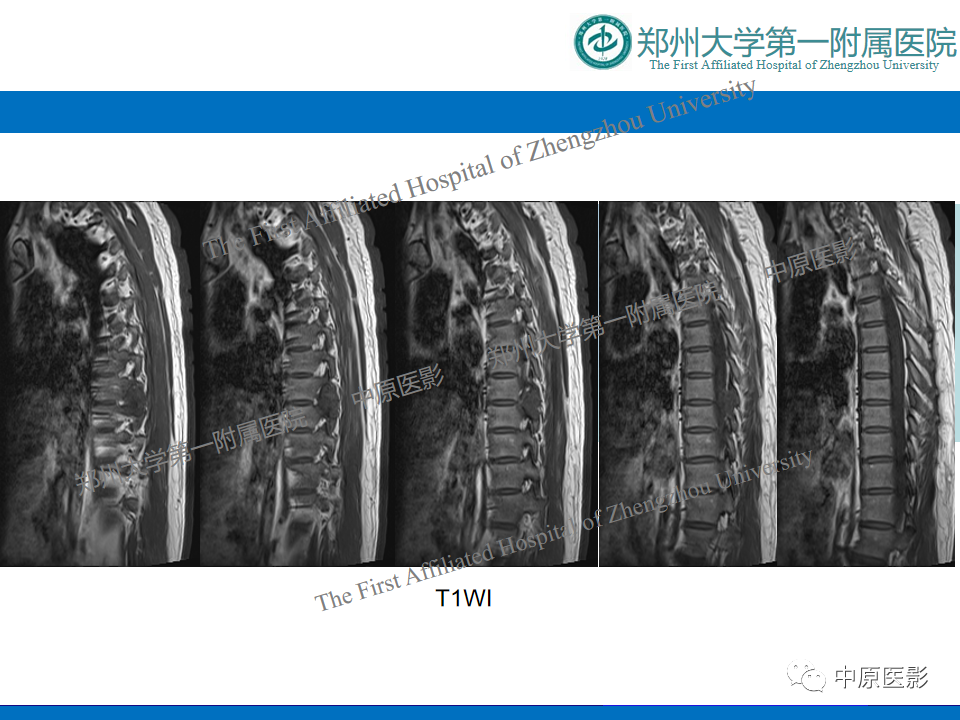 【病例】脊柱胸椎腱鞘巨细胞瘤1例CT及MR-3