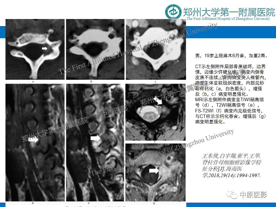 【病例】脊柱胸椎腱鞘巨细胞瘤1例CT及MR-17