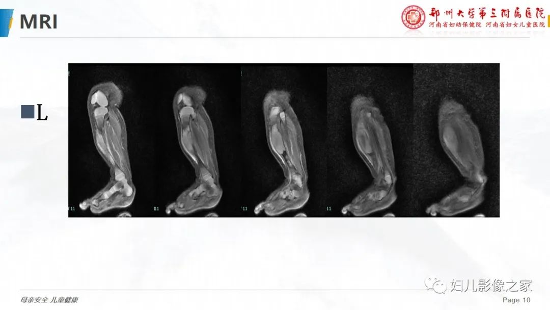 【PPT】骨纤维结构不良-10