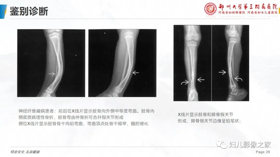 【PPT】骨纤维结构不良-26