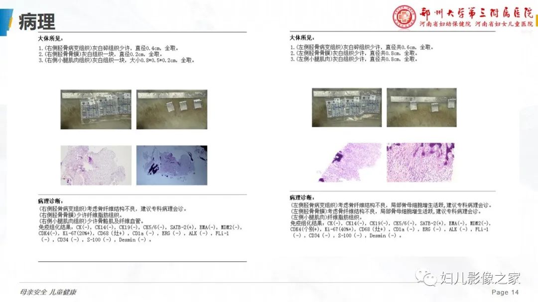 【PPT】骨纤维结构不良-14