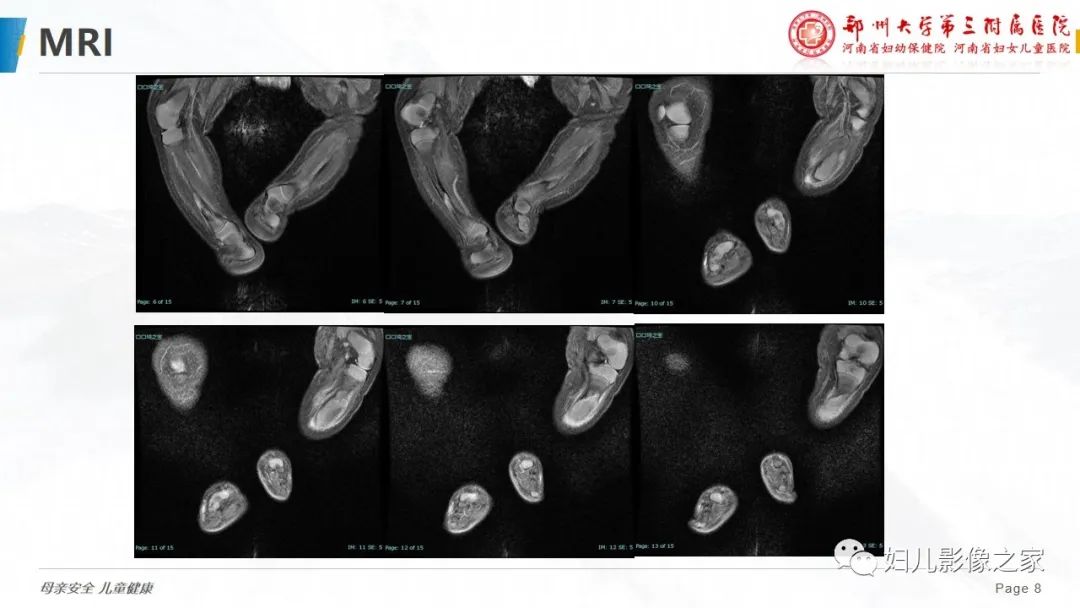 【PPT】骨纤维结构不良-8