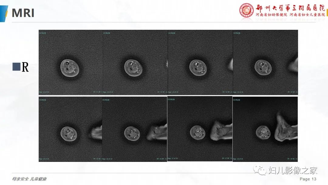 【PPT】骨纤维结构不良-13