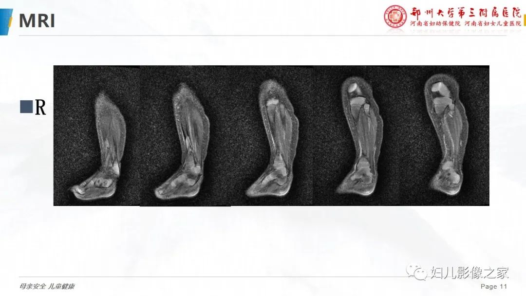 【PPT】骨纤维结构不良-11