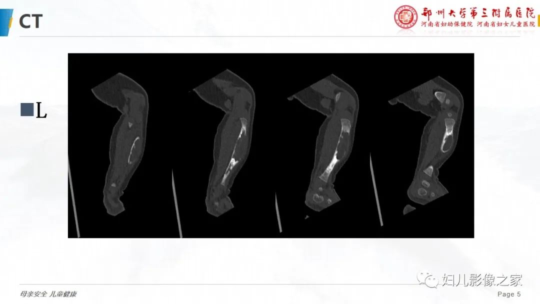 【PPT】骨纤维结构不良-5