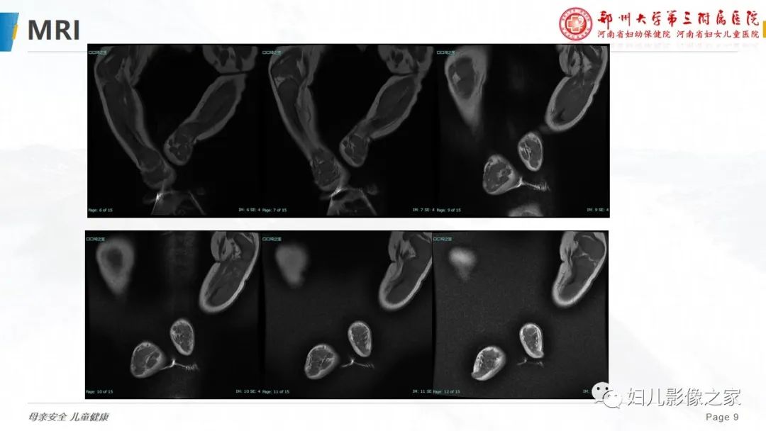 【PPT】骨纤维结构不良-9