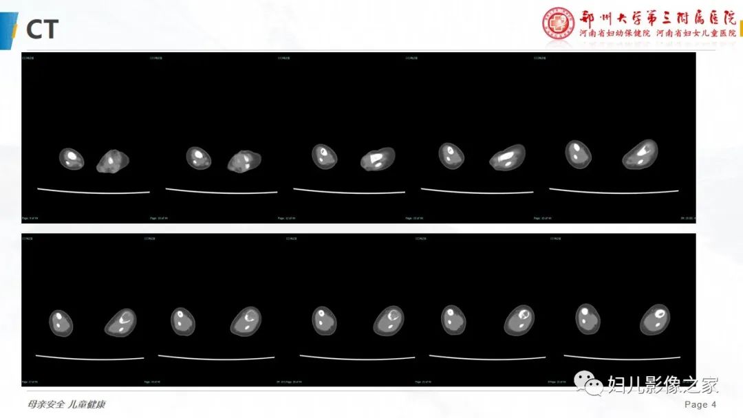 【PPT】骨纤维结构不良-4