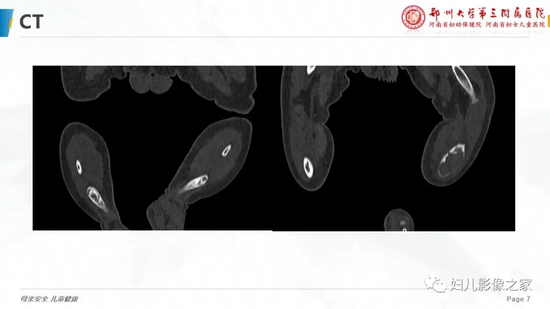 【PPT】骨纤维结构不良-7