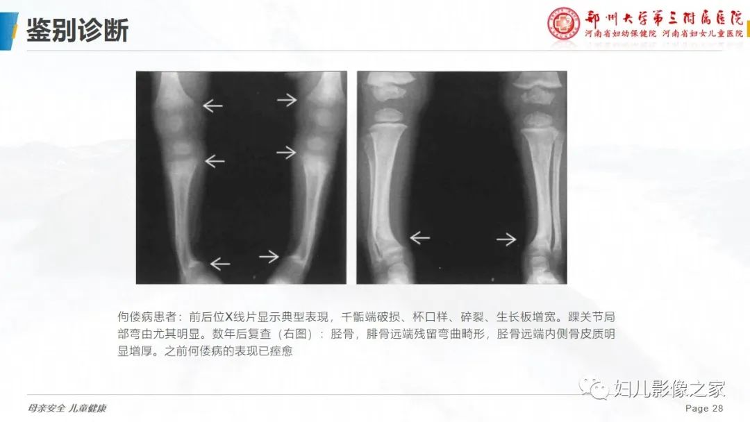 【PPT】骨纤维结构不良-28