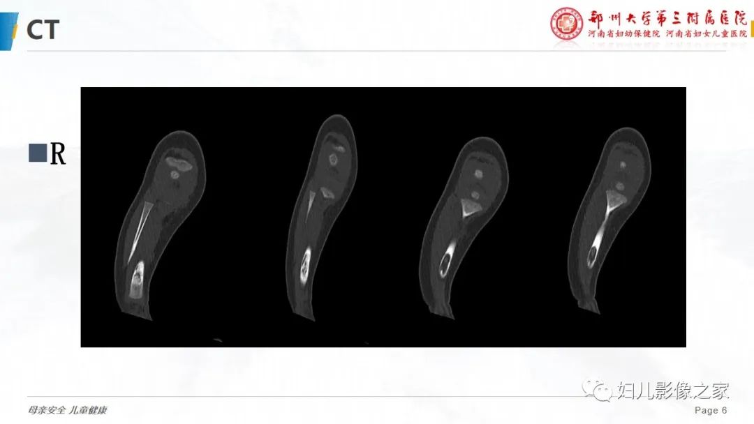 【PPT】骨纤维结构不良-6