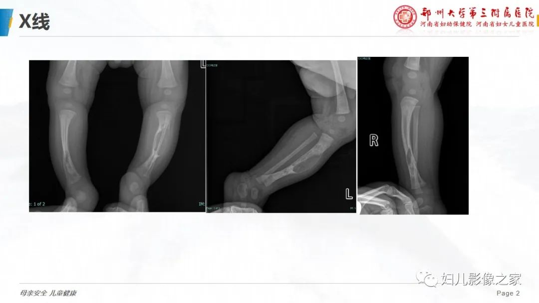 【PPT】骨纤维结构不良-2