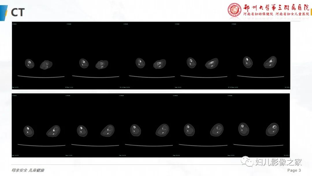 【PPT】骨纤维结构不良-3