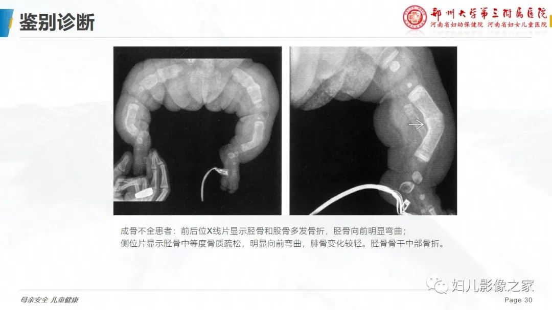 【PPT】骨纤维结构不良-30