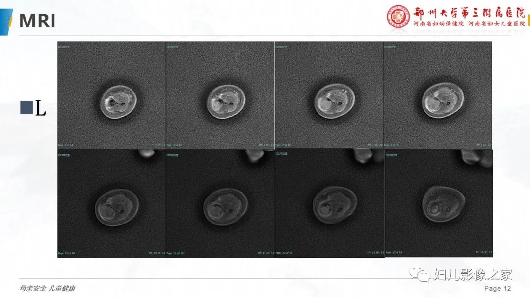 【PPT】骨纤维结构不良-12