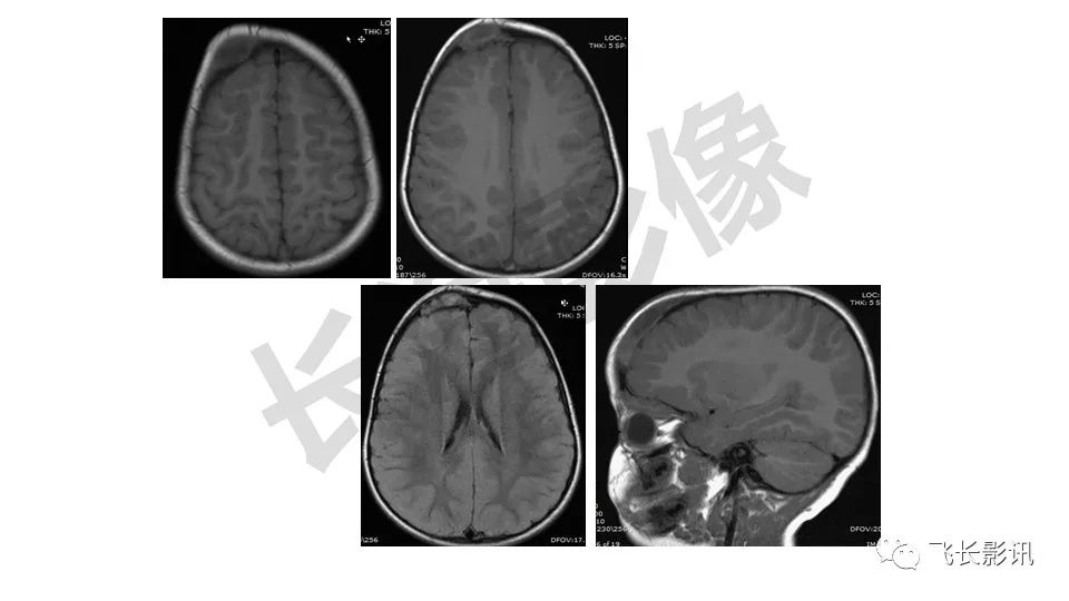 【PPT】骨嗜酸性肉芽肿-18