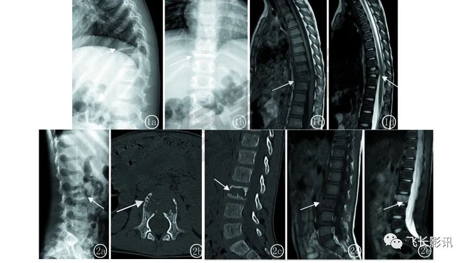 【PPT】骨嗜酸性肉芽肿-26