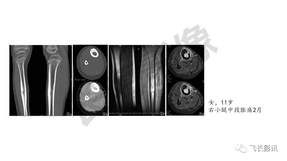 【PPT】骨嗜酸性肉芽肿-30