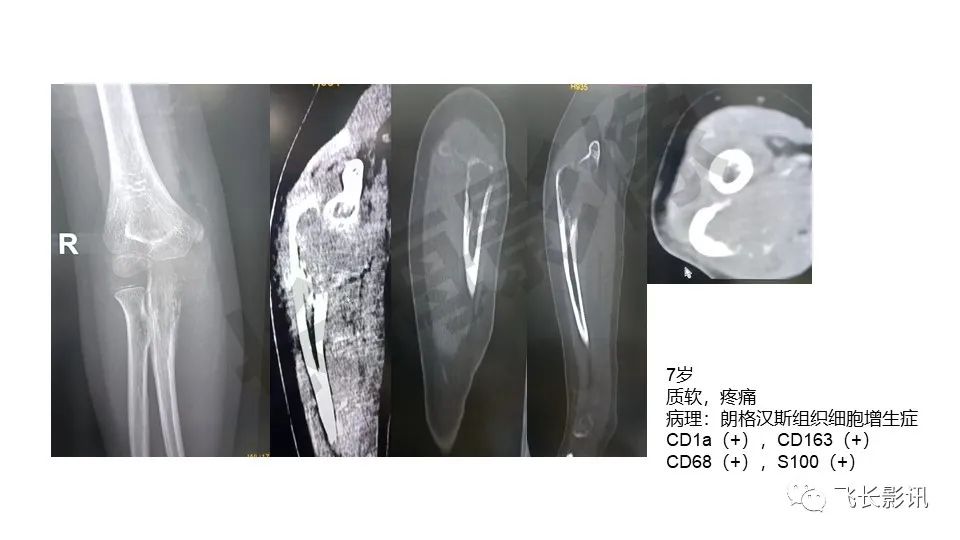 【PPT】骨嗜酸性肉芽肿-31