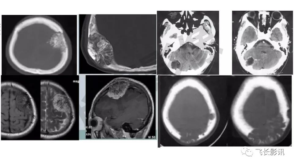 【PPT】骨嗜酸性肉芽肿-24