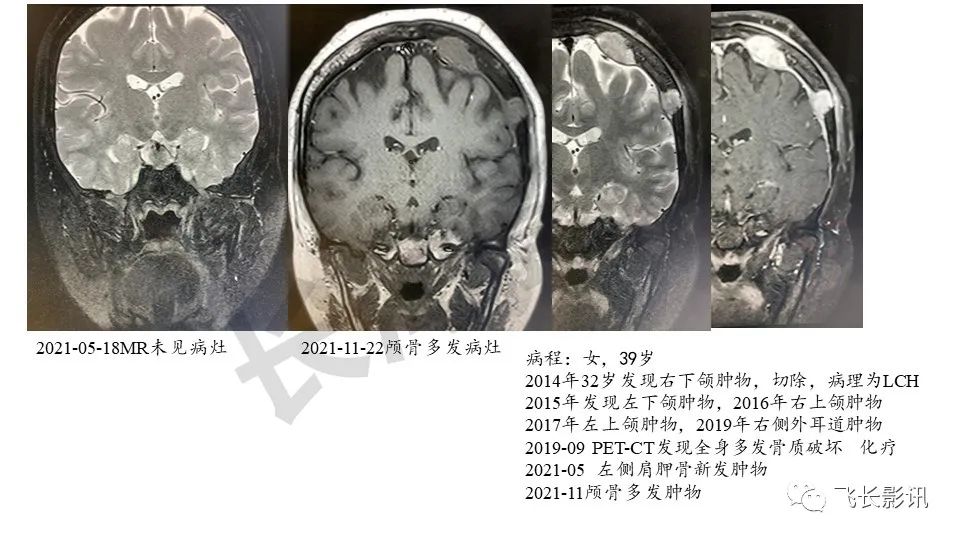 【PPT】骨嗜酸性肉芽肿-15