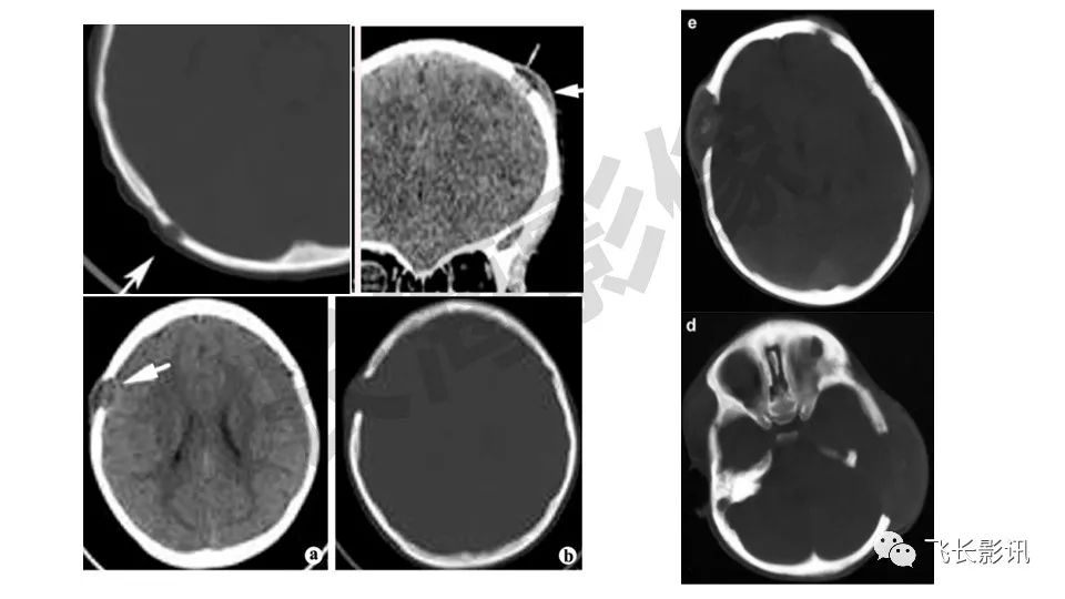 【PPT】骨嗜酸性肉芽肿-14