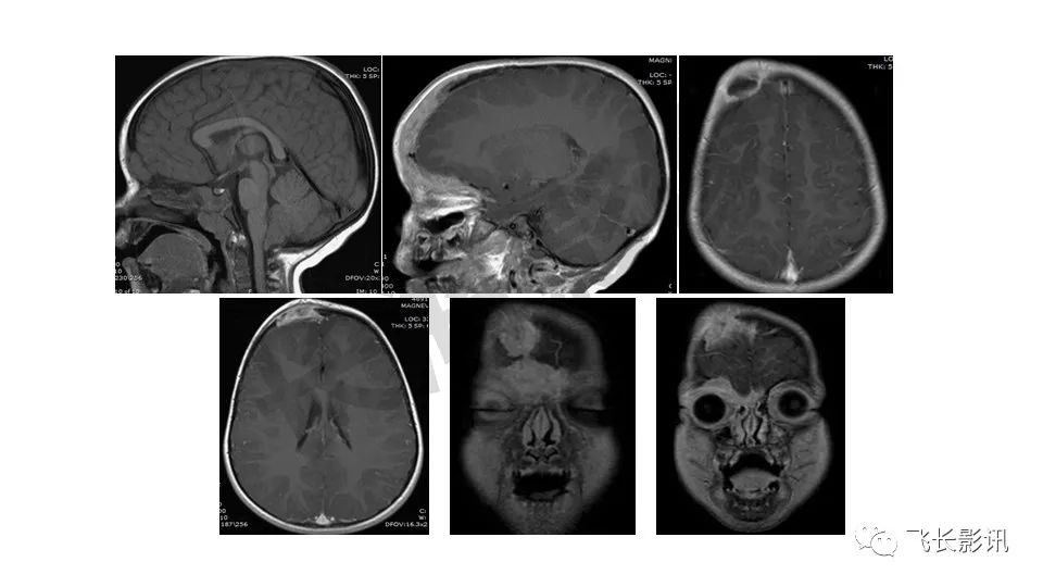 【PPT】骨嗜酸性肉芽肿-19