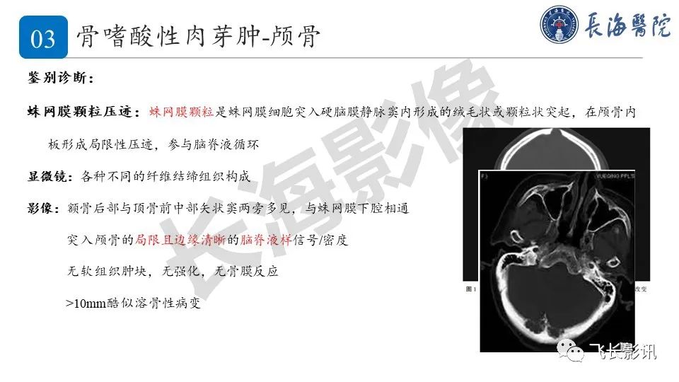 【PPT】骨嗜酸性肉芽肿-22