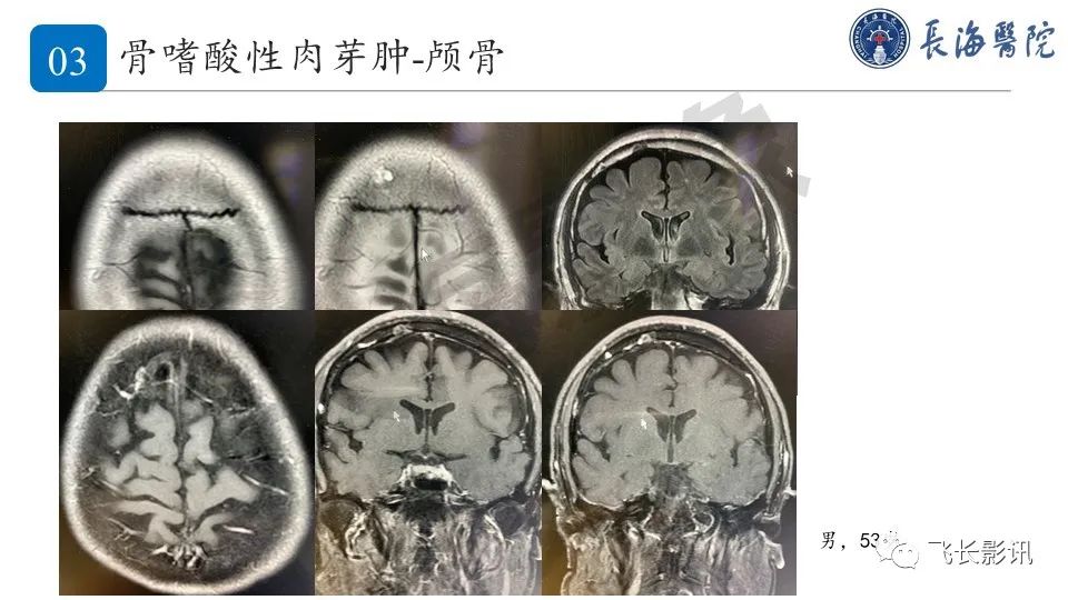 【PPT】骨嗜酸性肉芽肿-23