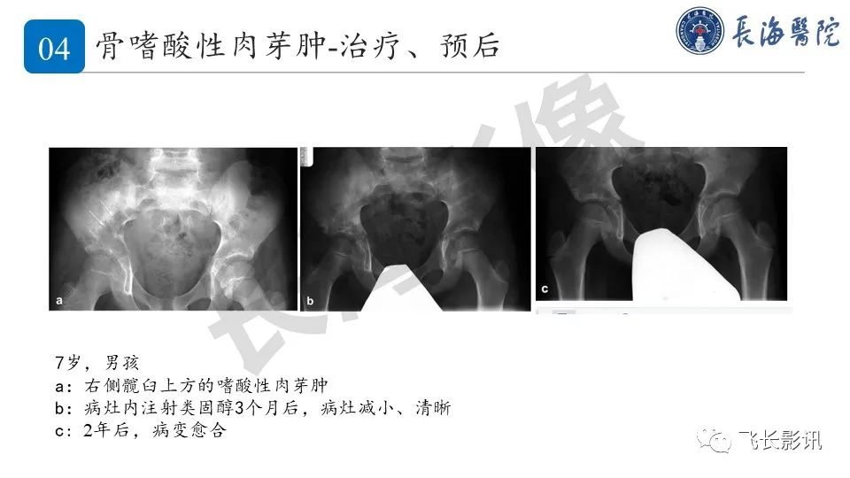【PPT】骨嗜酸性肉芽肿-35